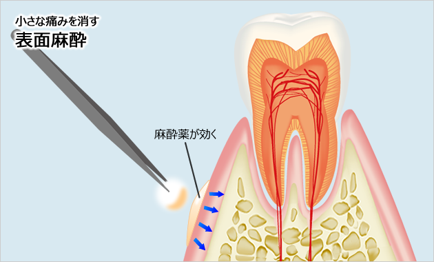 麻酔針の痛みを緩和させる「表面麻酔」