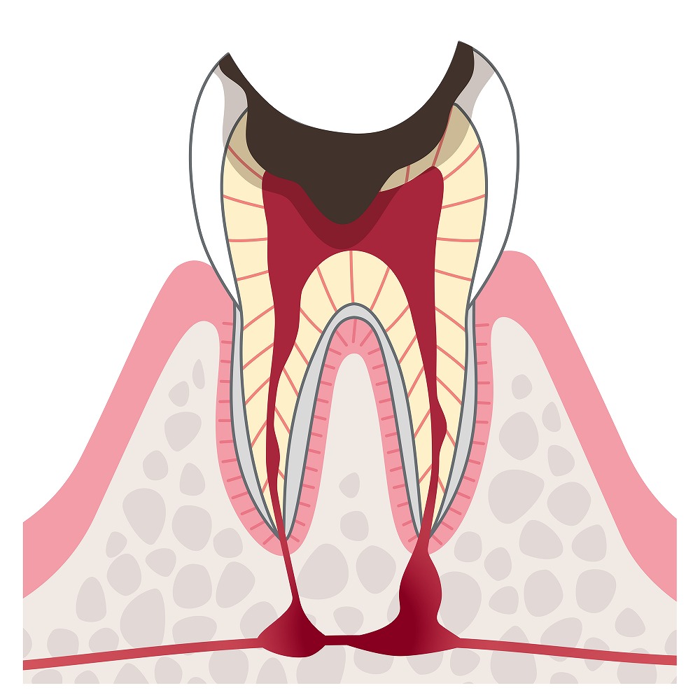 歯冠がこわれ、歯の根が残った虫歯