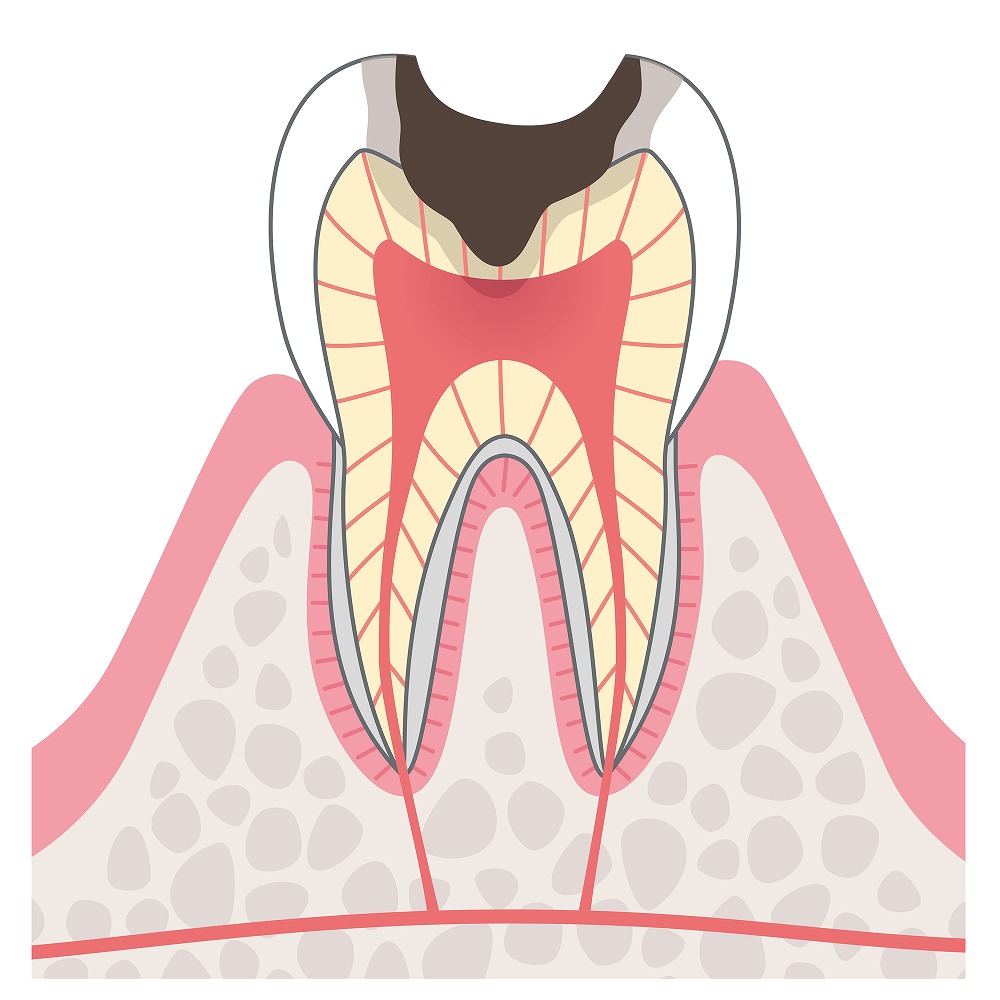 C3歯髄まで進んだ虫歯