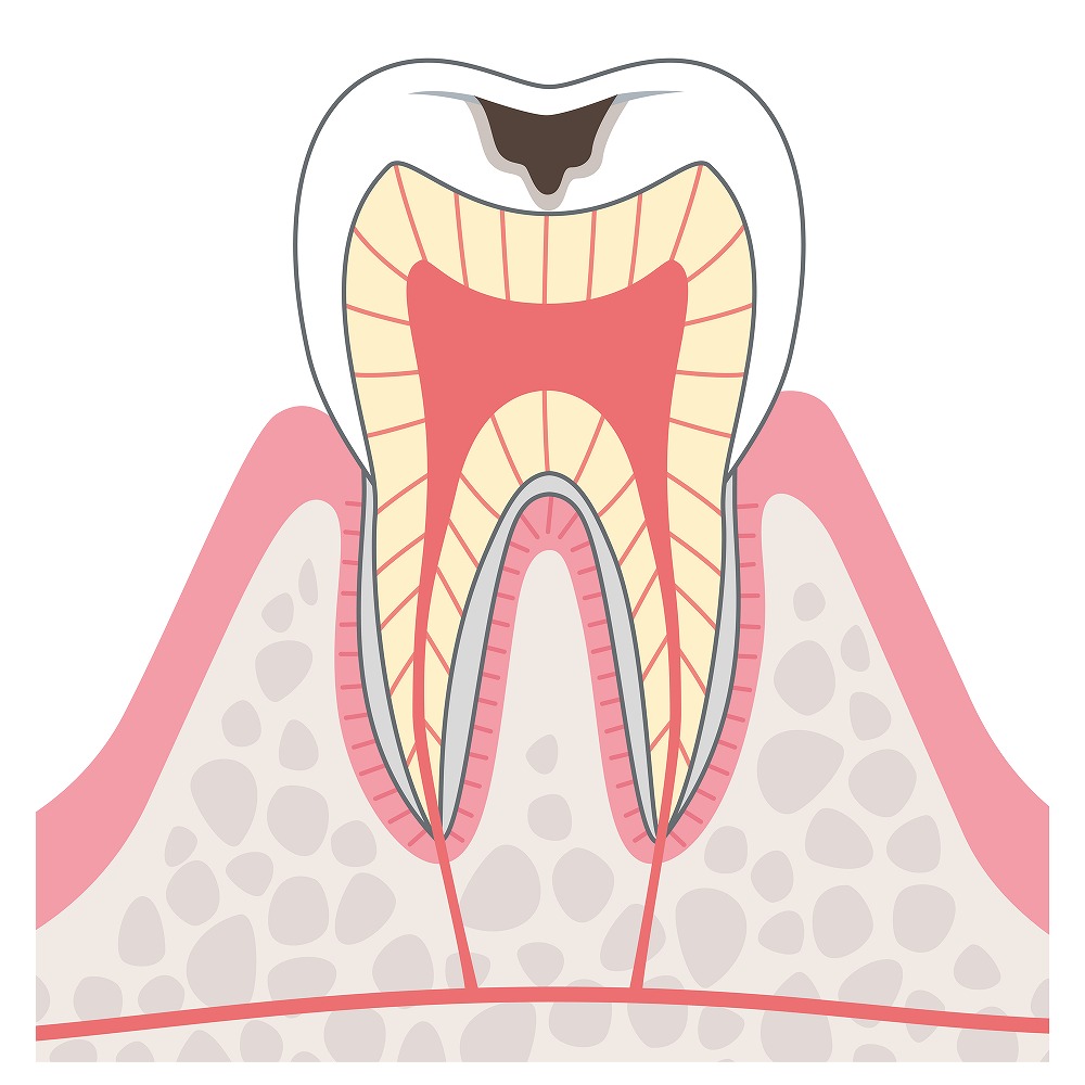 C2象牙質まで進んだ虫歯