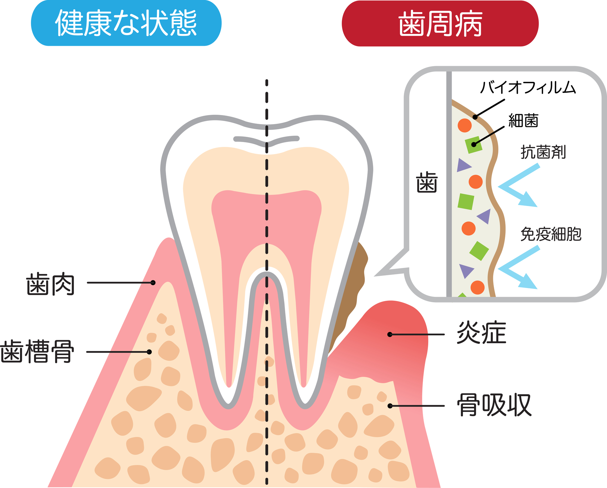 歯周病の原因は歯垢・歯石